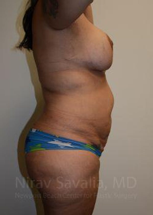 Abdominoplasty Tummy Tuck Before & After Gallery - Patient 1655657 - Before