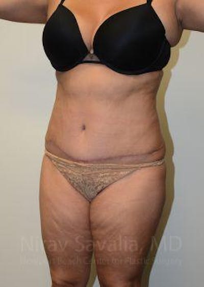Liposuction Before & After Gallery - Patient 1655664 - After