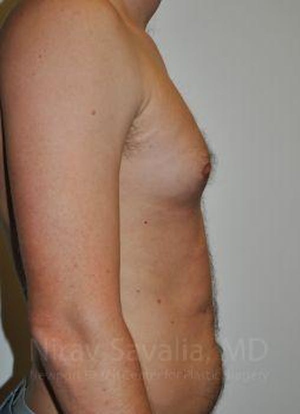 Breast Explantation En Bloc Capsulectomy Before & After Gallery - Patient 1655667 - Before