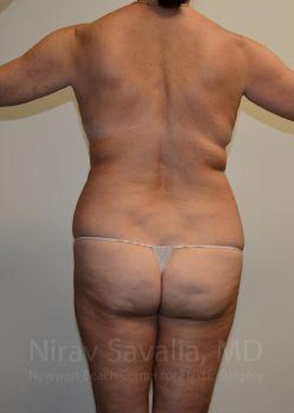 Breast Explantation En Bloc Capsulectomy Before & After Gallery - Patient 1655676 - Before