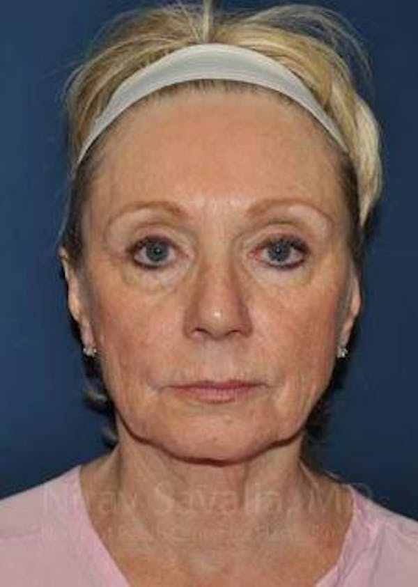 Facelift Before & After Gallery - Patient 1655682 - Before