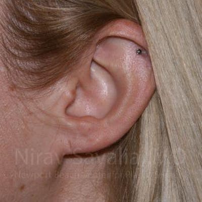 Torn Earlobe Repair Ear Gauge Repair Before & After Gallery - Patient 1655679 - Before