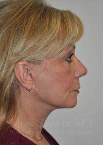 Breast Lift without Implants Before & After Gallery - Patient 1655682 - After