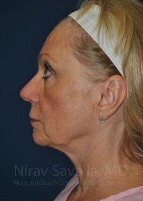 Facelift Before & After Gallery - Patient 1655682 - Before