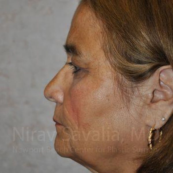 Brow Lift Before & After Gallery - Patient 1655687 - Before