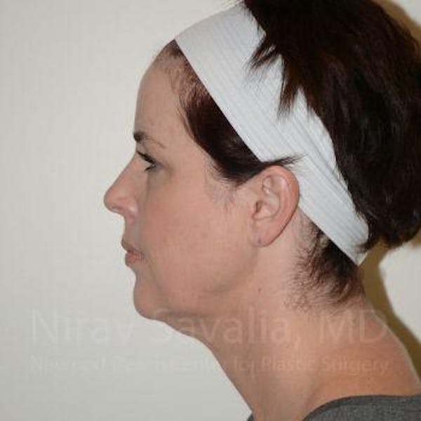 Facelift Before & After Gallery - Patient 1655689 - Before