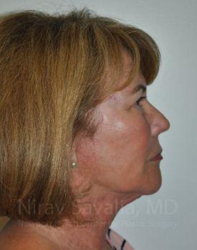 Facelift Before & After Gallery - Patient 1655695 - After