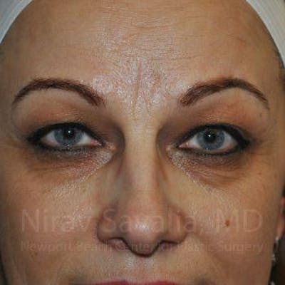 Eyelid Surgery Before & After Gallery - Patient 1655701 - Before