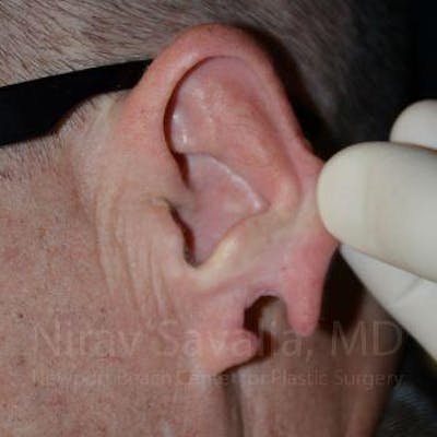 Torn Earlobe Repair Ear Gauge Repair Before & After Gallery - Patient 1655700 - Before