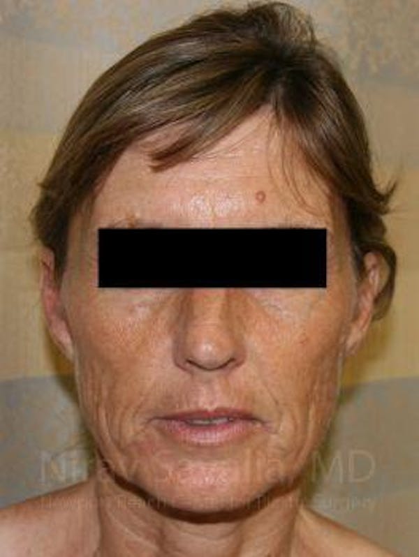 Mommy Makeover Before & After Gallery - Patient 1655704 - Before