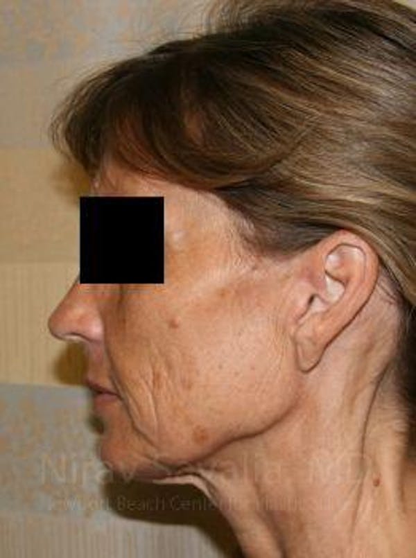 Mommy Makeover Before & After Gallery - Patient 1655704 - Before