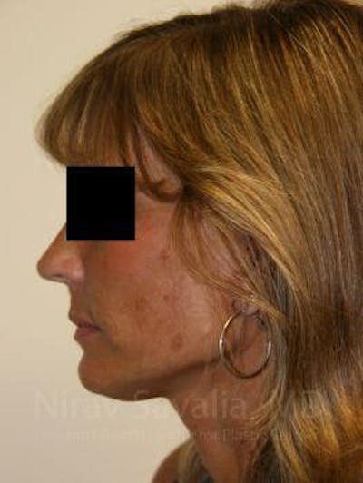 Mommy Makeover Before & After Gallery - Patient 1655704 - After