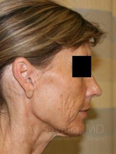 Mommy Makeover Before & After Gallery - Patient 1655704 - Before