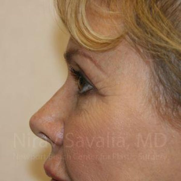 Oncoplastic Reconstruction Before & After Gallery - Patient 1655706 - Before