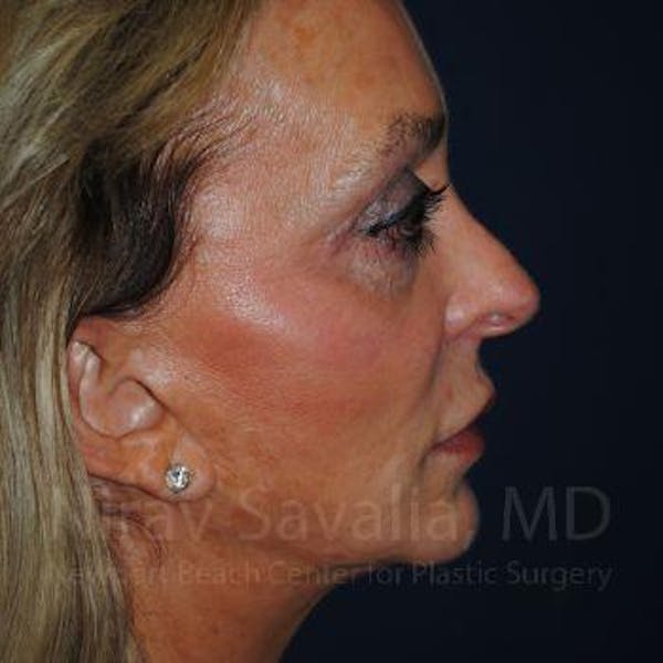 Mastectomy Reconstruction Before & After Gallery - Patient 1655730 - Before