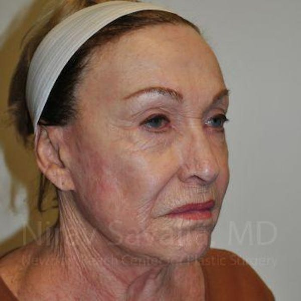 Brow Lift Before & After Gallery - Patient 1655786 - Before