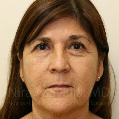 Facelift Before & After Gallery - Patient 1655793 - Before