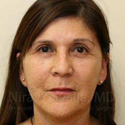 Facelift Before & After Gallery - Patient 1655793 - After