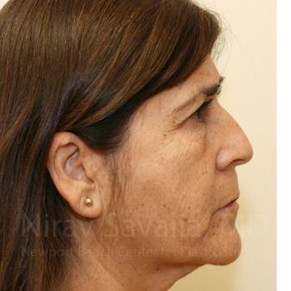 Facelift Before & After Gallery - Patient 1655793 - Before