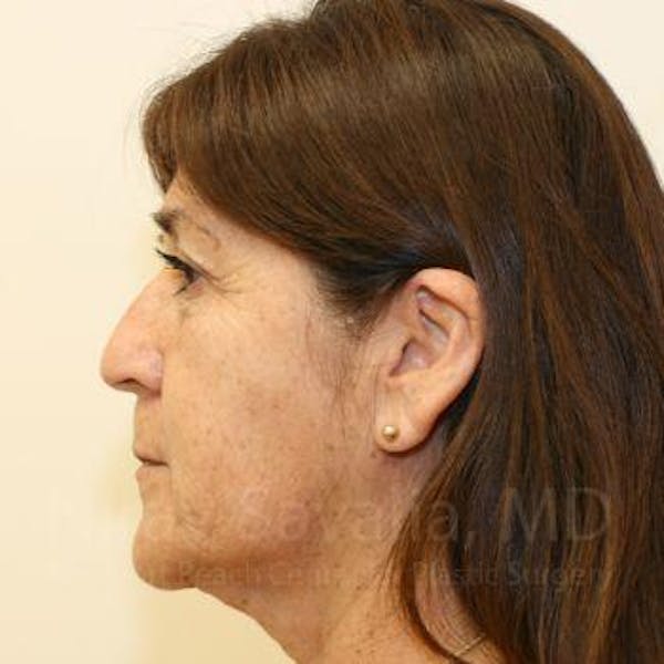 Facelift Before & After Gallery - Patient 1655793 - Before