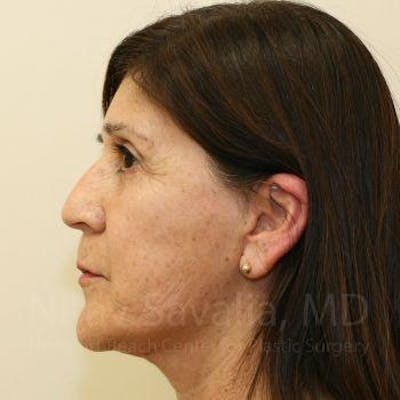 Facelift Before & After Gallery - Patient 1655793 - After