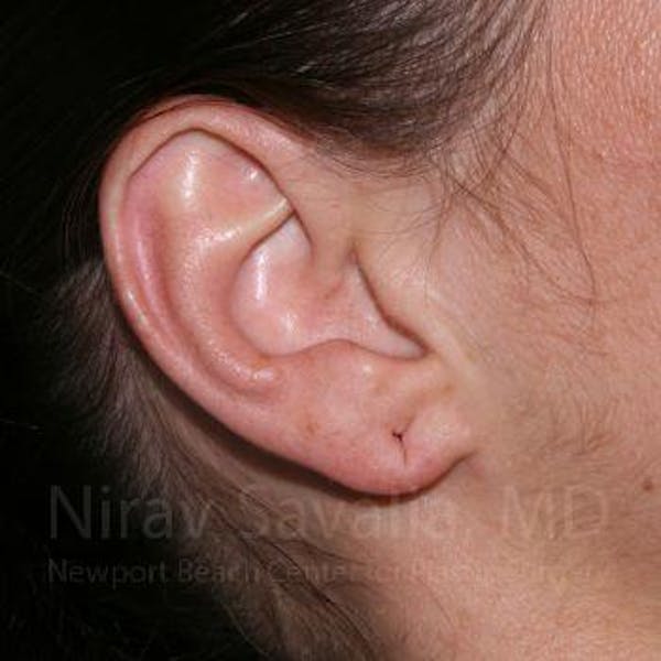 Torn Earlobe Repair Ear Gauge Repair Before & After Gallery - Patient 1655797 - Before