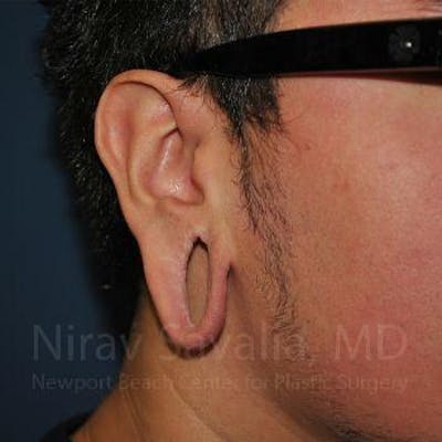 Oncoplastic Reconstruction Before & After Gallery - Patient 1655801 - Before