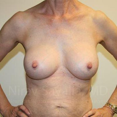Breast Explantation En Bloc Capsulectomy Before & After Gallery - Patient 1655447 - After