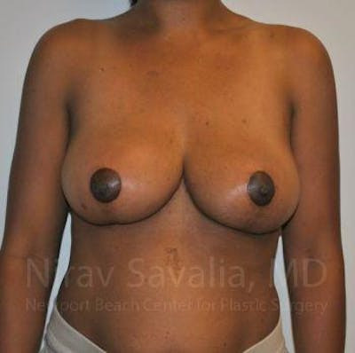 Oncoplastic Reconstruction Before & After Gallery - Patient 1655451