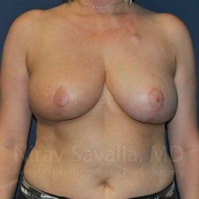 Oncoplastic Reconstruction Before & After Gallery - Patient 1655461