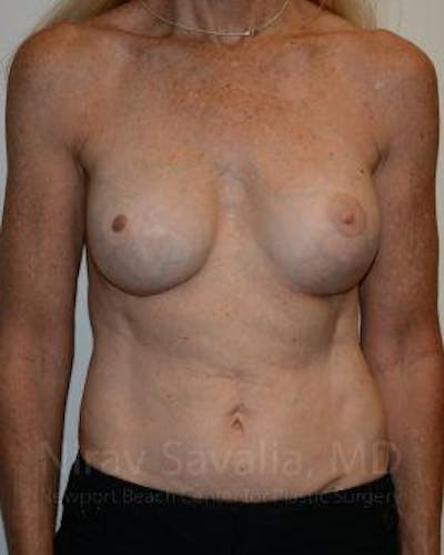 Oncoplastic Reconstruction Before & After Gallery - Patient 1655466