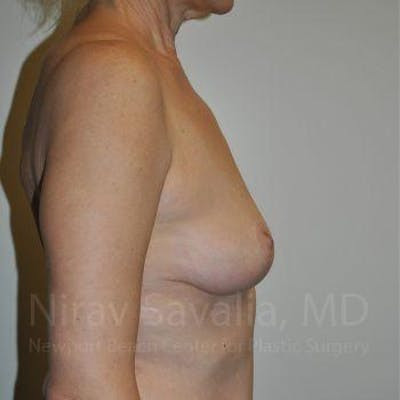 Fat Grafting to Face Before & After Gallery - Patient 1655472 - After