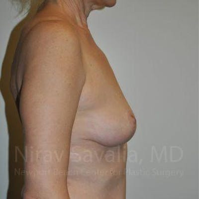 Breast Lift with Implants Before & After Gallery - Patient 1655472 - After