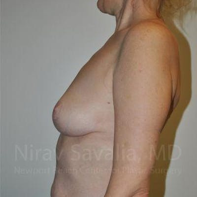 Body Contouring after Weight Loss Before & After Gallery - Patient 1655472 - After