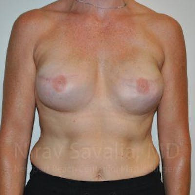 Oncoplastic Reconstruction Before & After Gallery - Patient 1655474