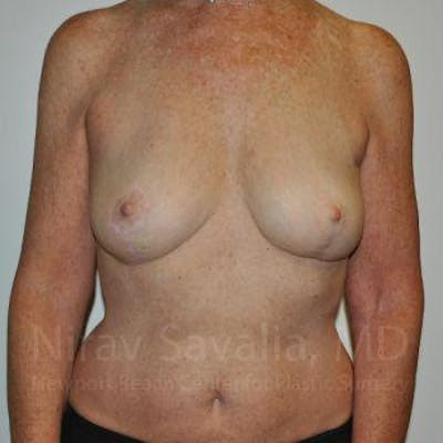 Breast Lift with Implants Before & After Gallery - Patient 1655481 - After