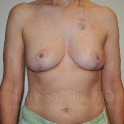 Oncoplastic Reconstruction Before & After Gallery - Patient 1655487