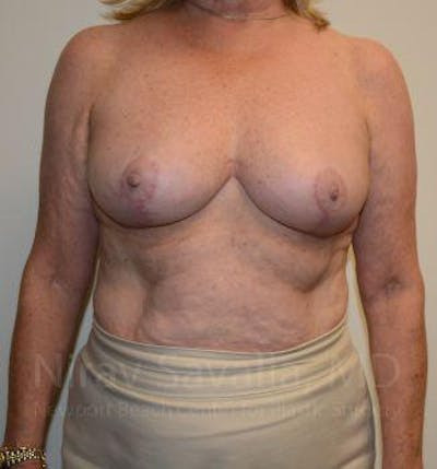 Mastectomy Reconstruction Before & After Gallery - Patient 1655496