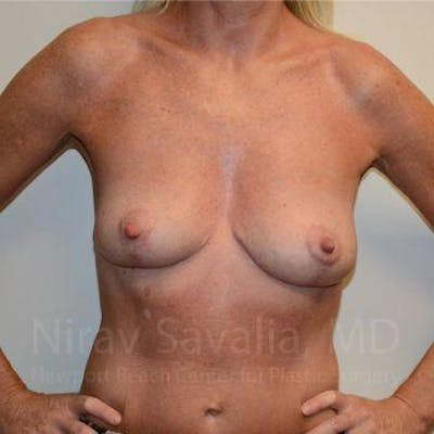 Breast Explantation En Bloc Capsulectomy Before & After Gallery - Patient 1655495 - After