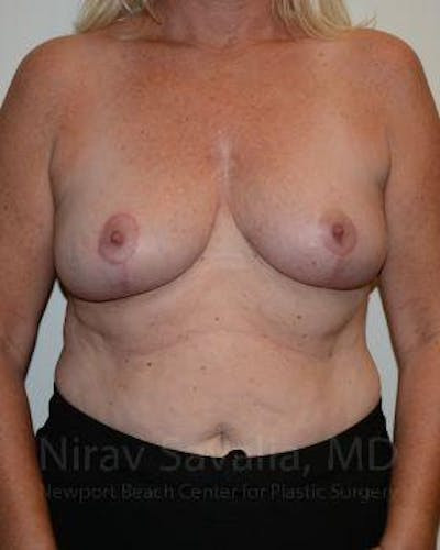 Liposuction Before & After Gallery - Patient 1655499 - After