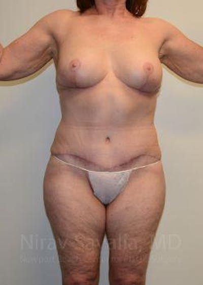 Mastectomy Reconstruction Before & After Gallery - Patient 1655509