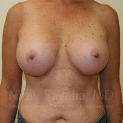 Oncoplastic Reconstruction Before & After Gallery - Patient 1655519