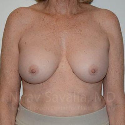 Oncoplastic Reconstruction Before & After Gallery - Patient 1655520