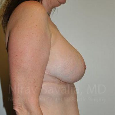 Fat Grafting to Face Before & After Gallery - Patient 1655526 - After