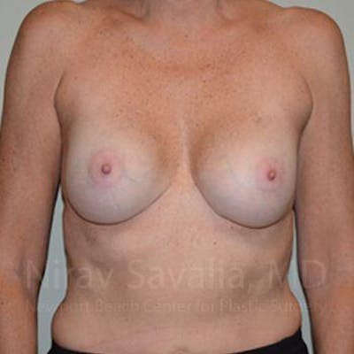 Mastectomy Reconstruction Before & After Gallery - Patient 1655570