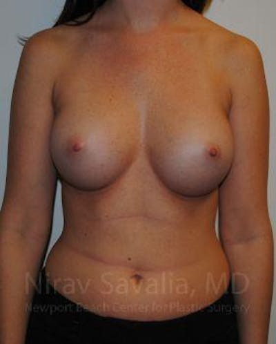 Mastectomy Reconstruction Before & After Gallery - Patient 1655574