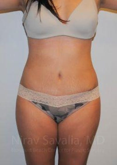 Mastectomy Reconstruction Before & After Gallery - Patient 1655599
