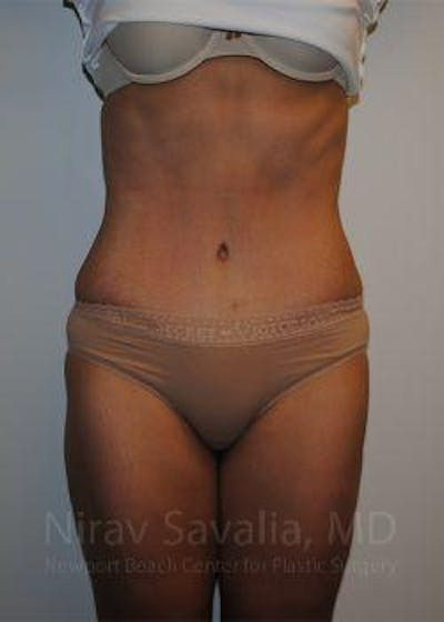 Breast Augmentation Before & After Gallery - Patient 1655601