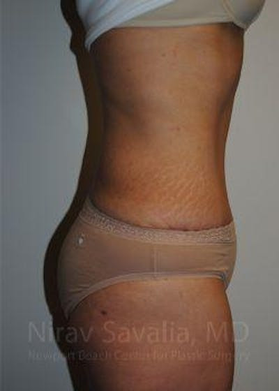 Breast Augmentation Before & After Gallery - Patient 1655601 - After