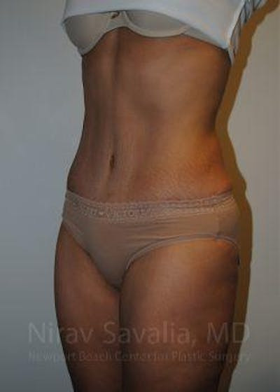 Breast Augmentation Before & After Gallery - Patient 1655601 - After